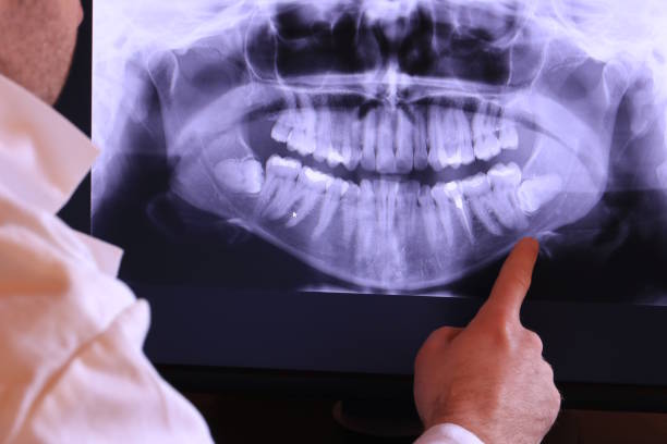 Best Emergency Dental Extractions in Lake City, FL