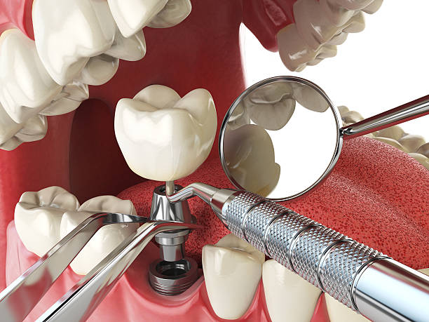 Best Broken or Cracked Tooth Emergency Dentist in Lake City, FL
